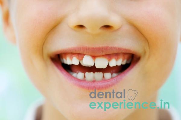 Overlapping Teeth